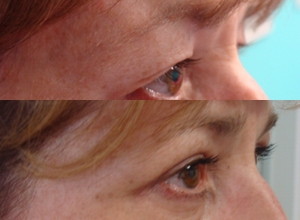 Upper blepharoplasty, after 3 weeks